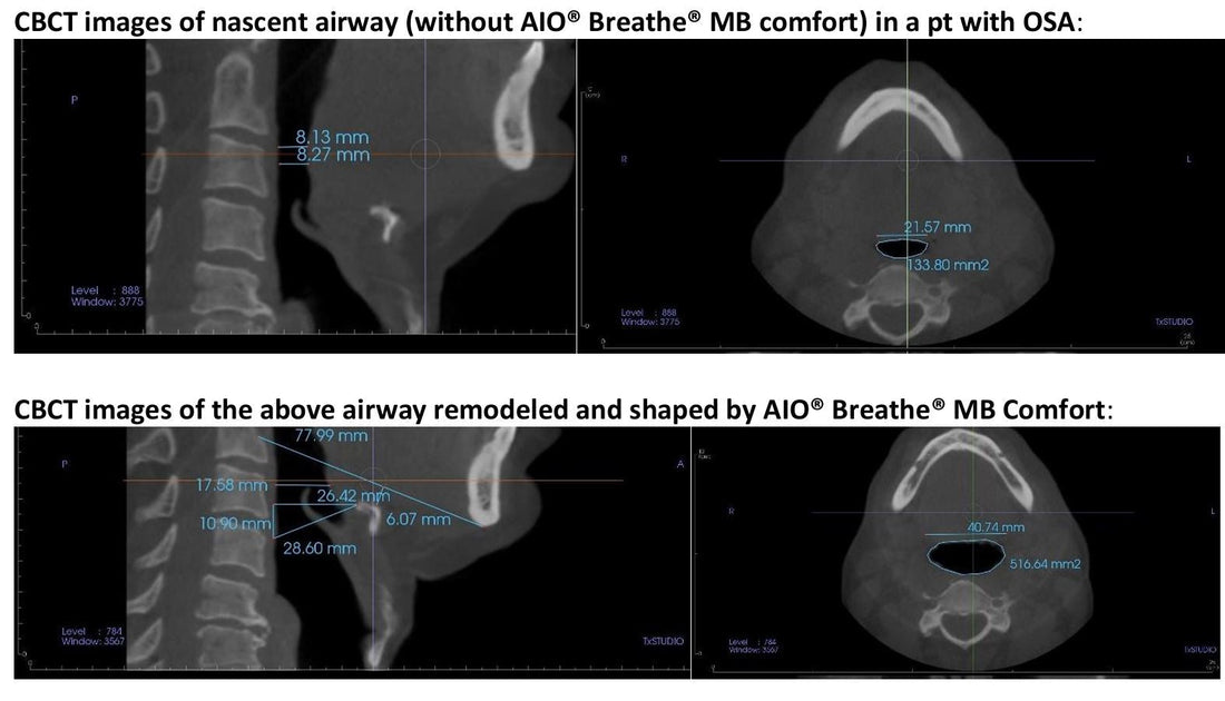 AIO BREATHE enlarges airway in OSA