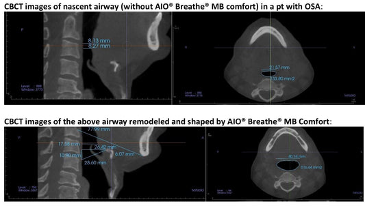AIO BREATHE enlarges airway in OSA